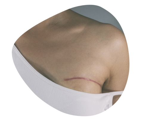 Eine Operationsnarbe quer über den oberen Ansatz der linken Brust.