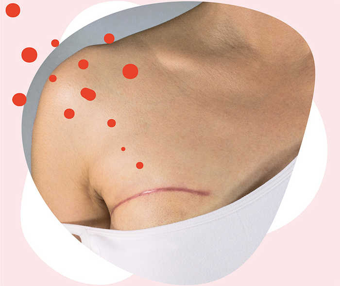 Leben mit Brustkrebs: Teaserbild zum Artikel Brustoperation Leben mit Brustkrebs: Teaserbild zum Artikel Brustoperation
