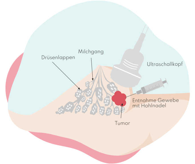 Die Biopsie Gewebeuntersuchung Leben Mit Brustkrebs