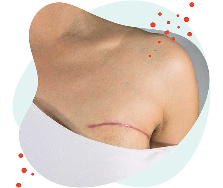 Leben mit Brustkrebs: Bild von einer Frau mit einer Mastektomie