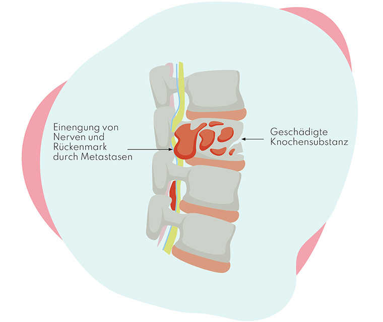 Leben mit Brustkrebs: Abbildung einer Wirbelsäule an der geschädigte Knochensubstanz gezeigt wird und die Metastasen das Rückenmark und Nerven einklemmen