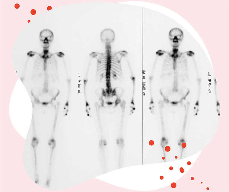 Behandlung Von Knochenmetastasen Leben Mit Brustkrebs