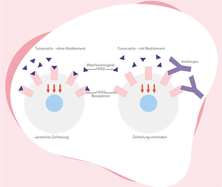 Leben mit Brustkrebs: Abbildung von HER2-POSITIVEM BRUSTKREBS