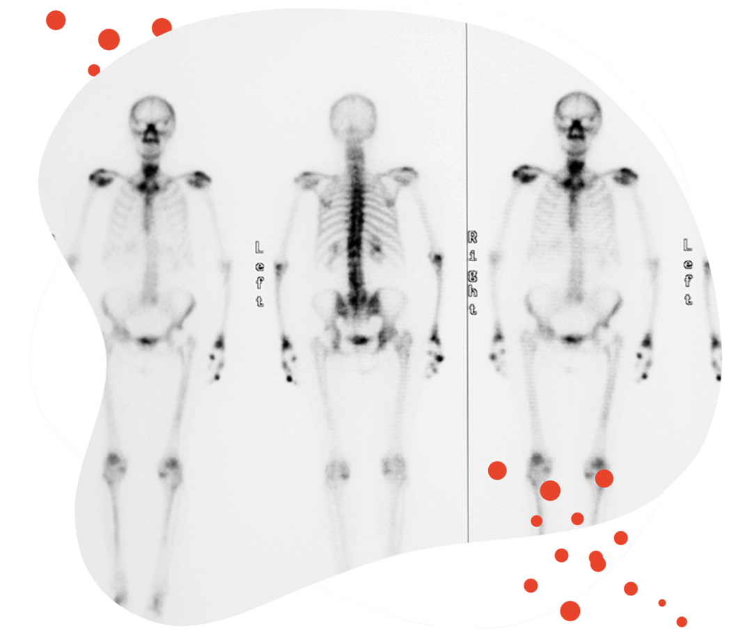 Leben mit Brustkrebs: Röntgenaufnahme eines ganzen Skelettes von mehreren Seiten